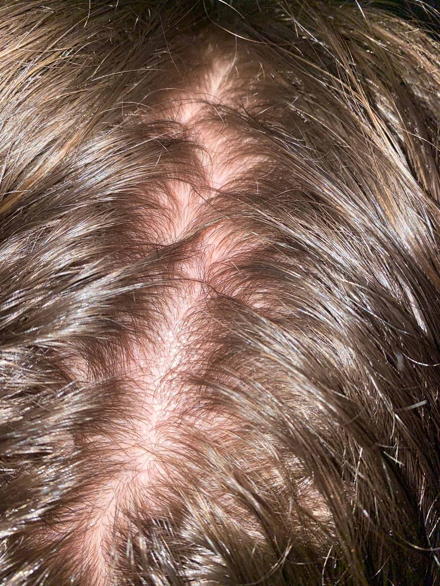 Scalp issues & how to resolve them | MUVO